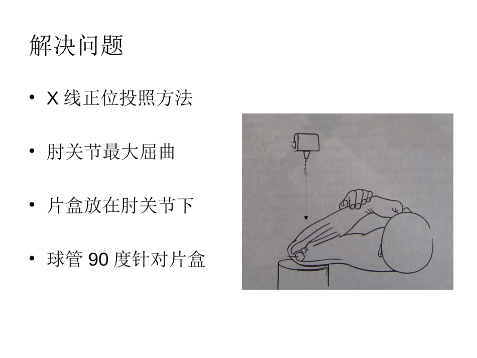 小儿肱骨髁上骨折_第15页