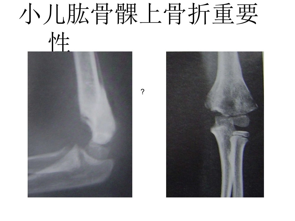小儿肱骨髁上骨折_第2页
