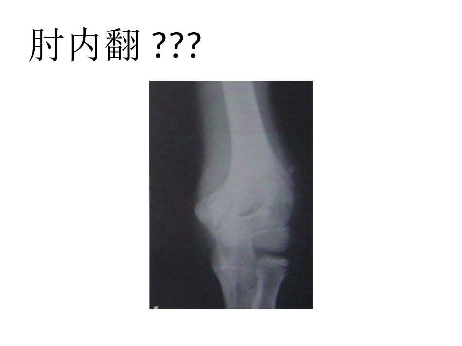 小儿肱骨髁上骨折_第3页