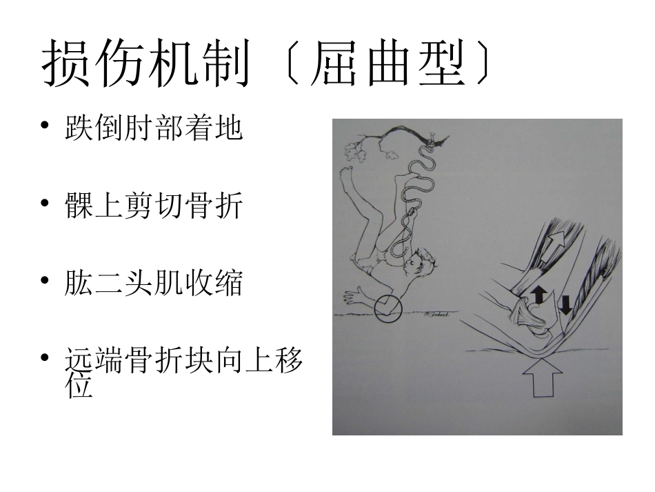 小儿肱骨髁上骨折_第7页