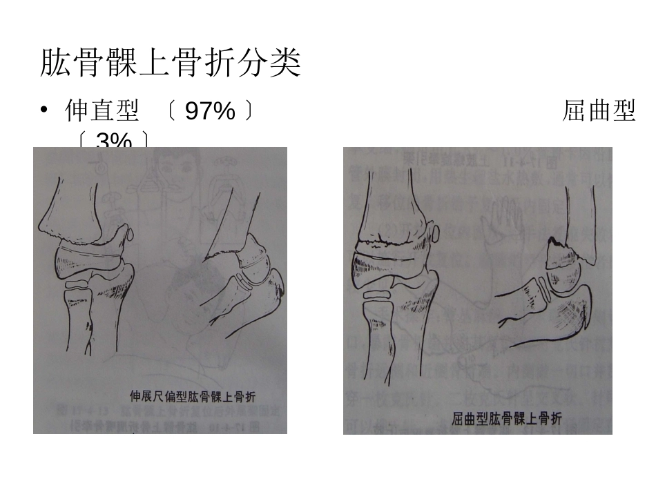 小儿肱骨髁上骨折_第8页