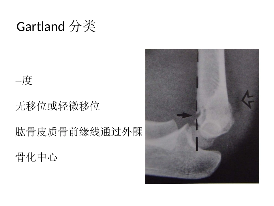小儿肱骨髁上骨折_第9页
