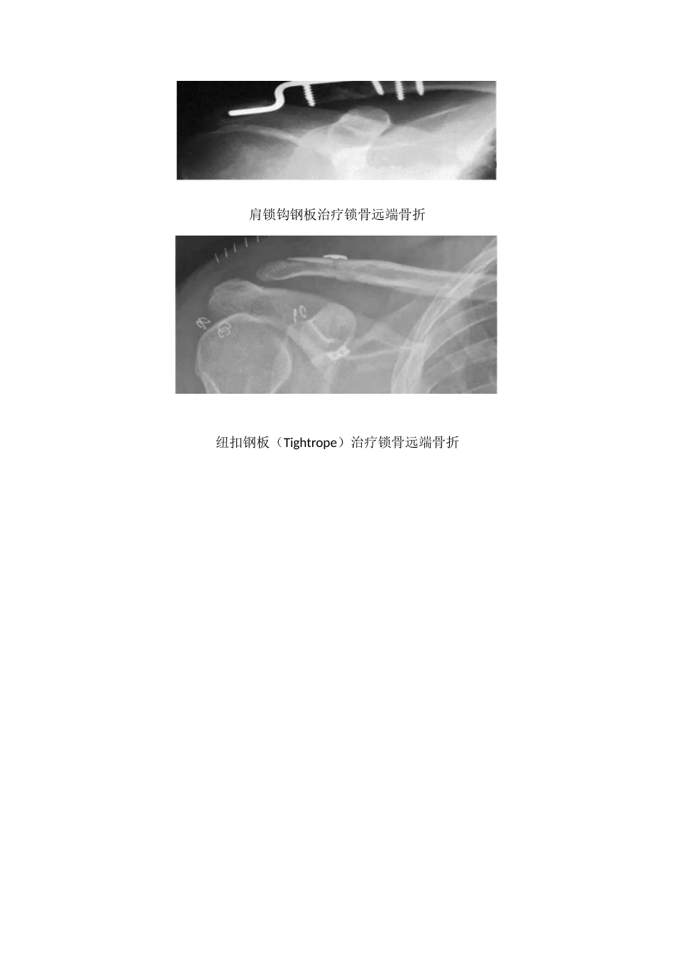 锁骨远端骨折的分型及治疗_第7页