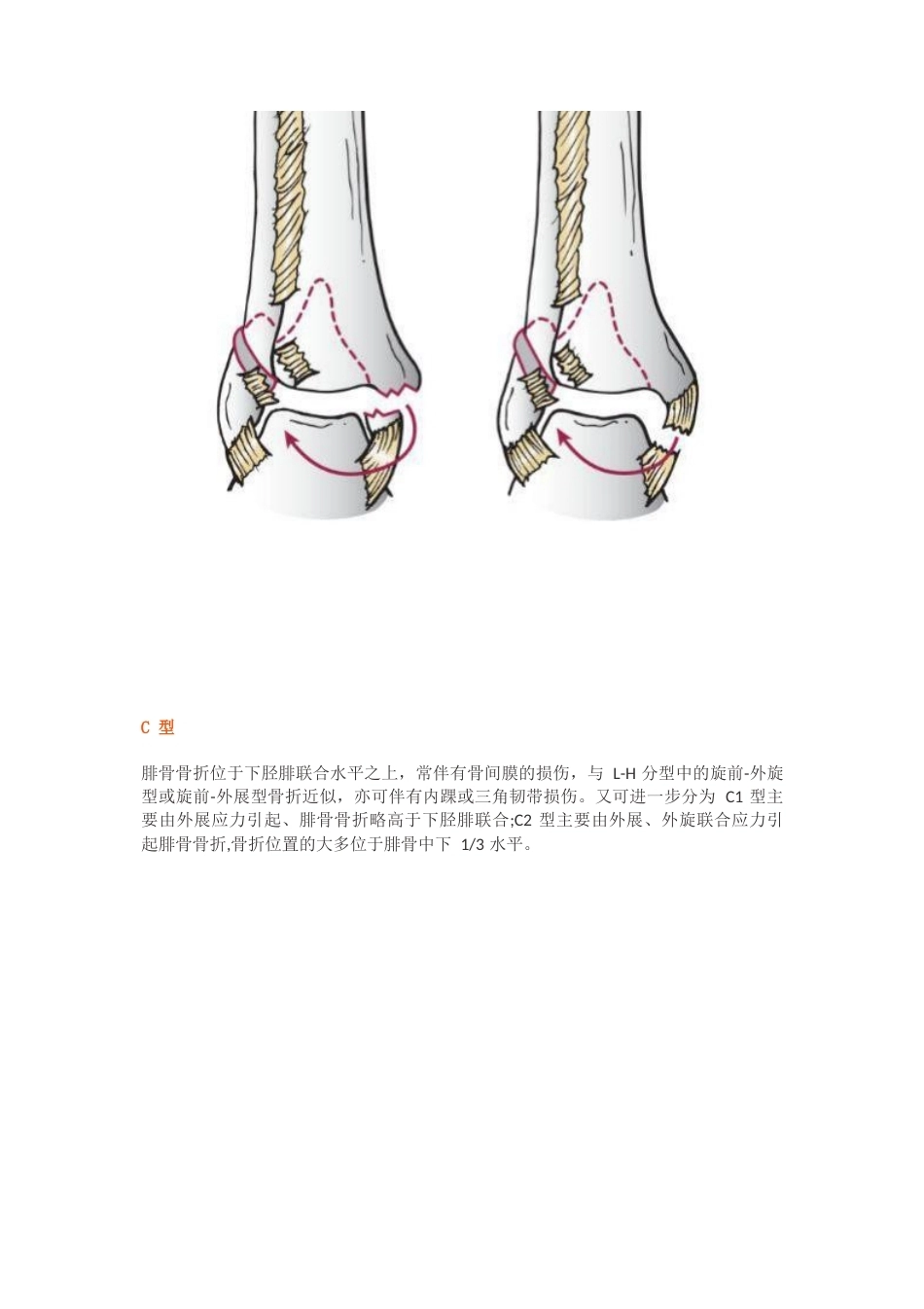 踝关节骨折的Lauge-Hansen分型_第10页
