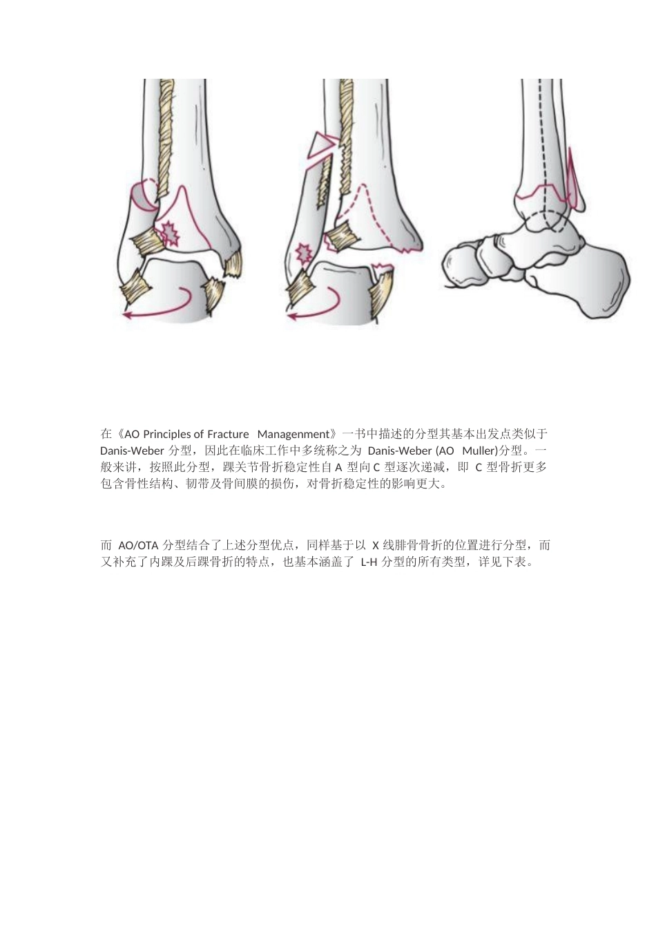 踝关节骨折的Lauge-Hansen分型_第11页