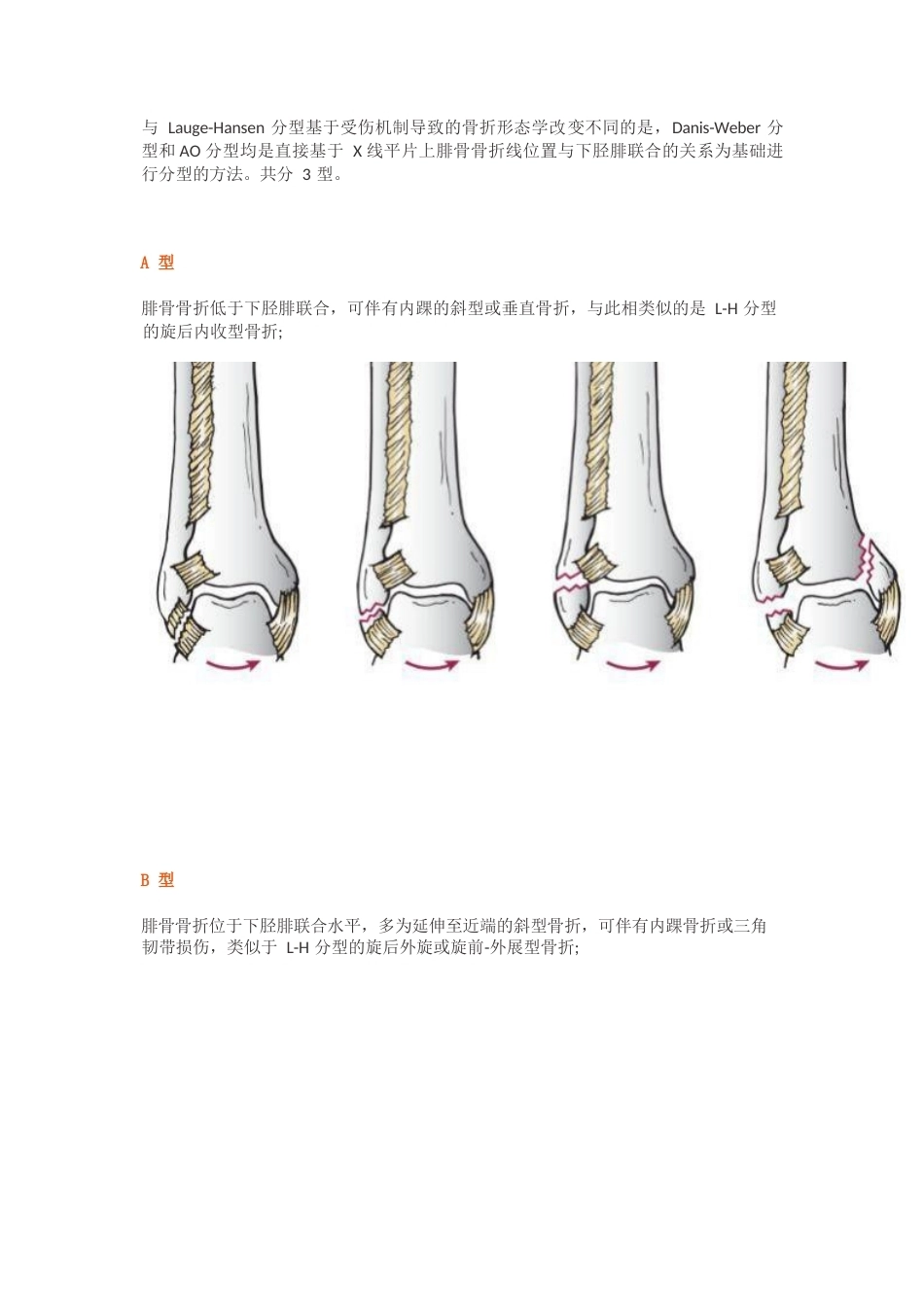 踝关节骨折的Lauge-Hansen分型_第9页