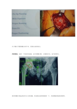 髋关节置换手术中如何做 一个好的髋臼