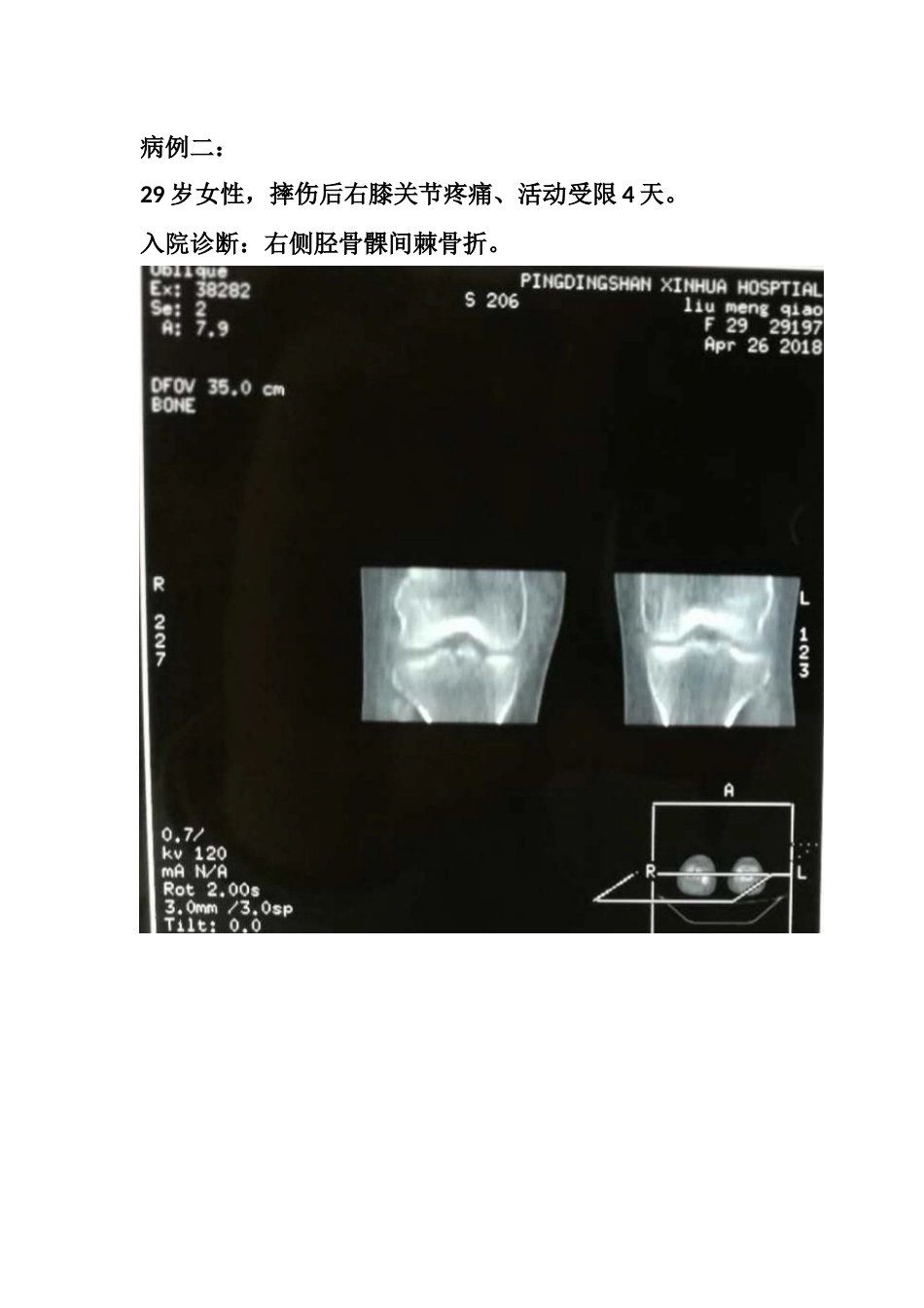 胫骨髁间 脊骨折_第10页
