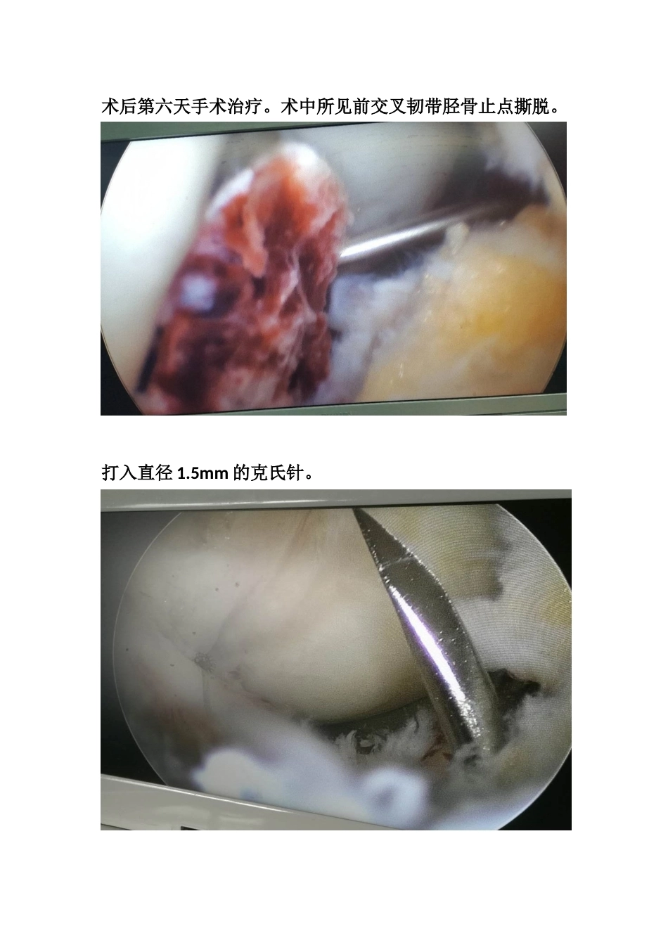 胫骨髁间 脊骨折_第11页