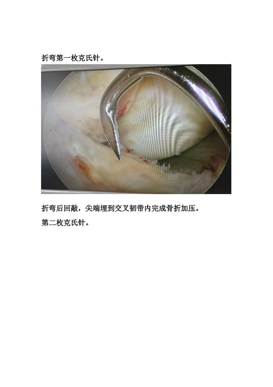 胫骨髁间 脊骨折_第12页