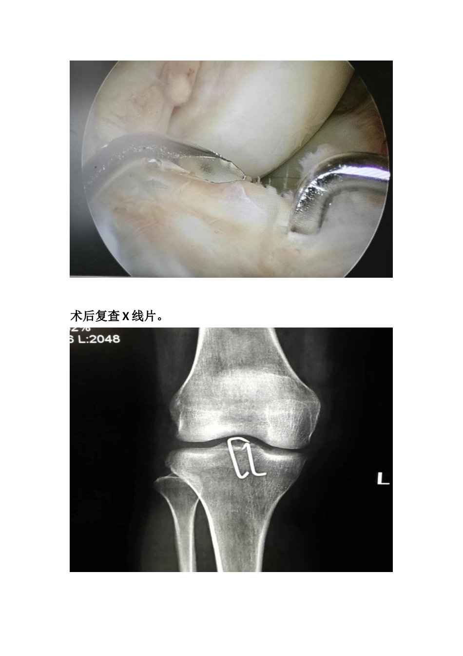 胫骨髁间 脊骨折_第13页