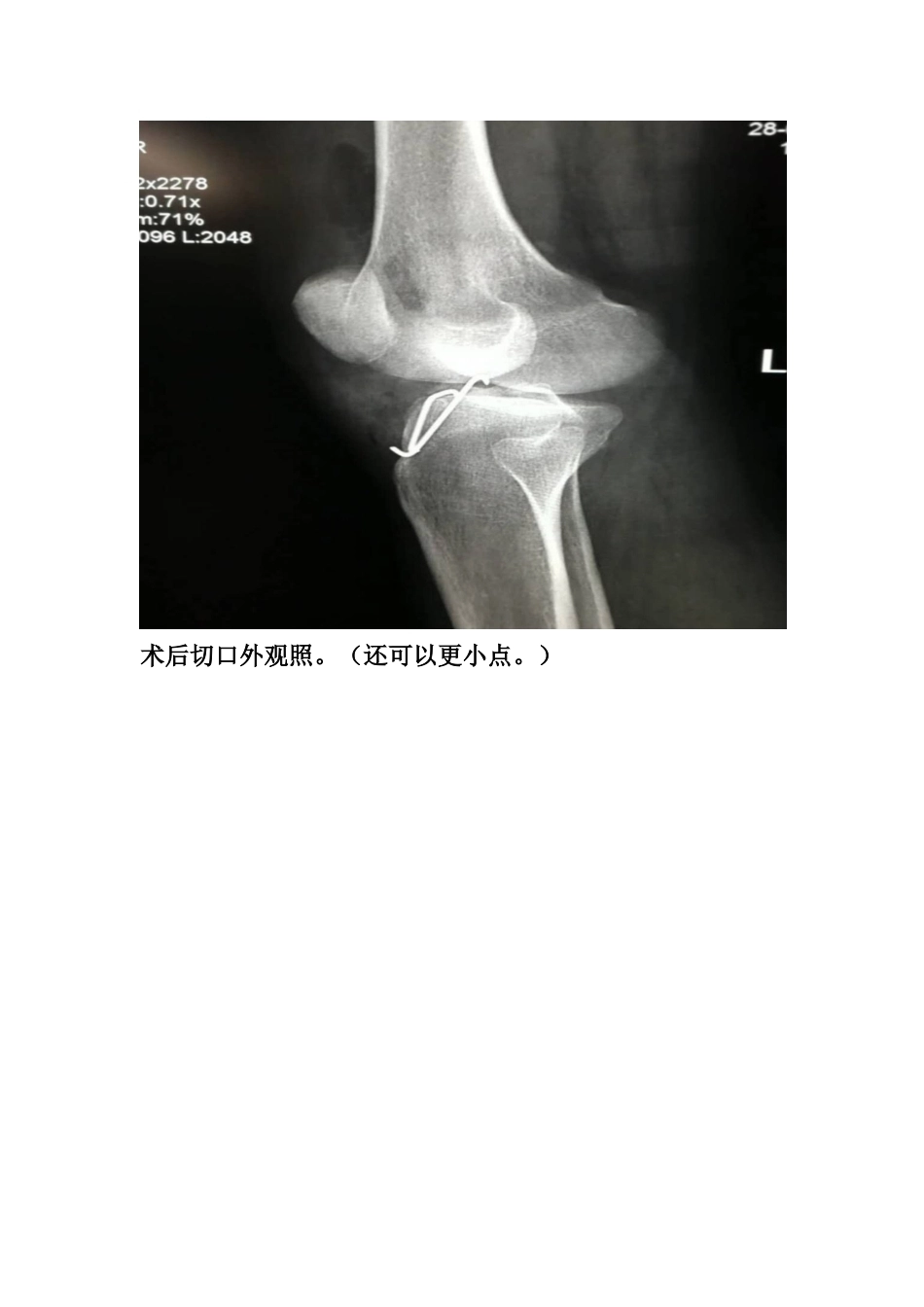 胫骨髁间 脊骨折_第14页