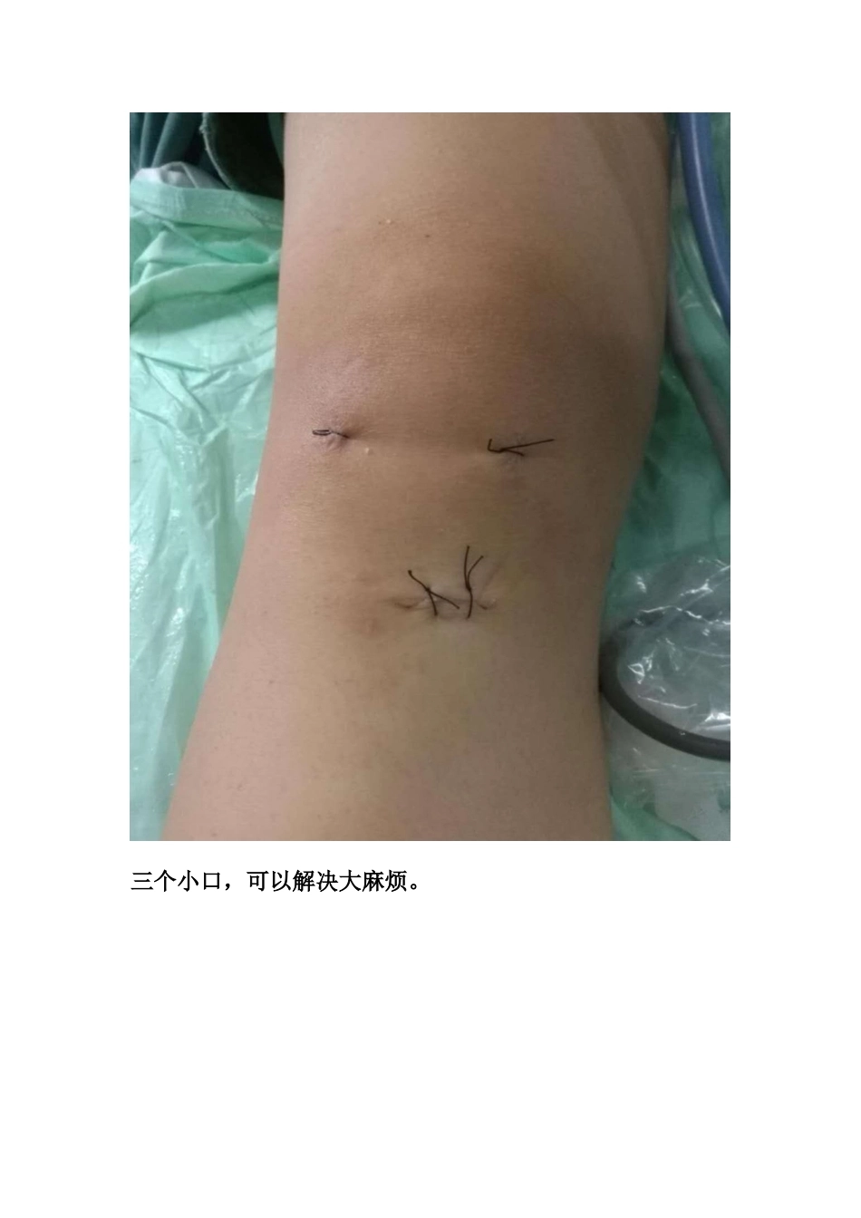 胫骨髁间 脊骨折_第15页