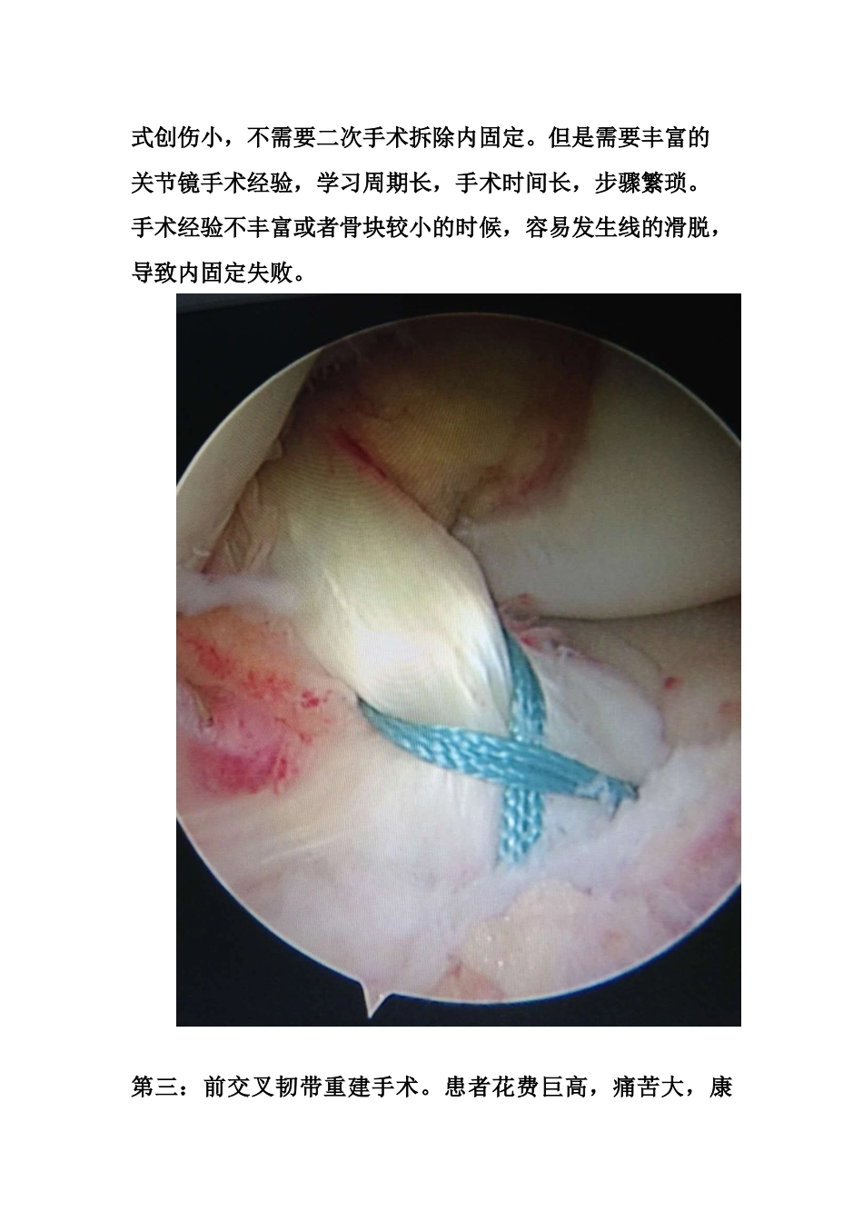 胫骨髁间 脊骨折_第2页