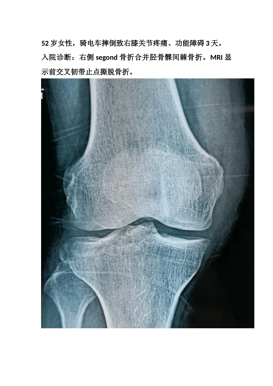 胫骨髁间 脊骨折_第5页