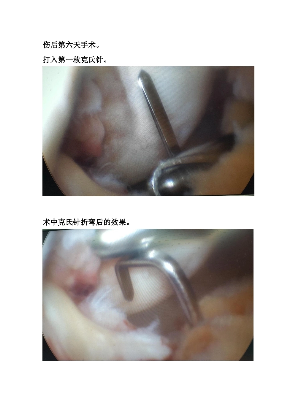 胫骨髁间 脊骨折_第7页