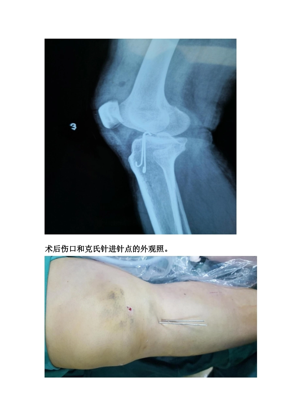 胫骨髁间 脊骨折_第9页