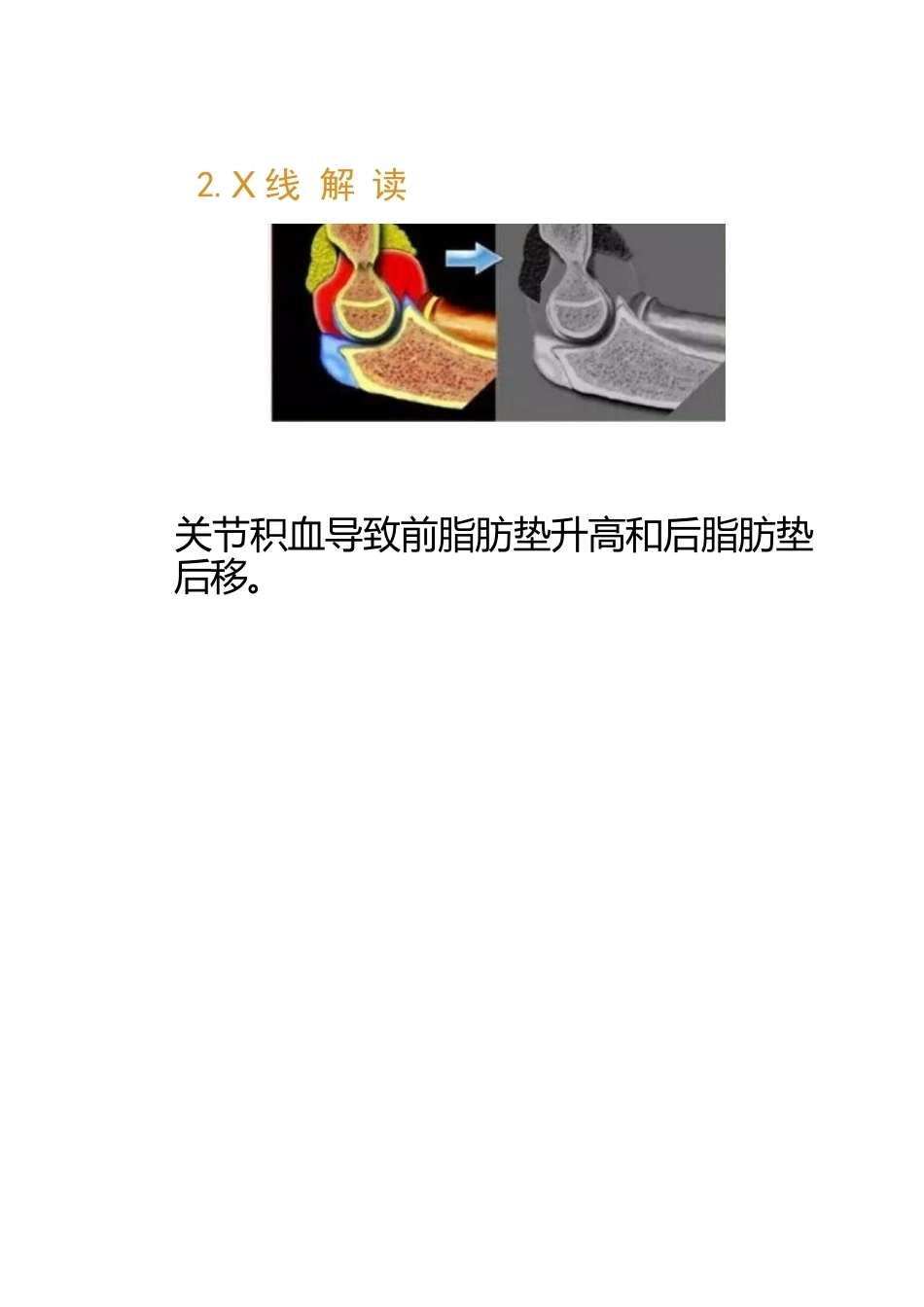 儿童肘关节骨折的分类与诊断要点_第11页