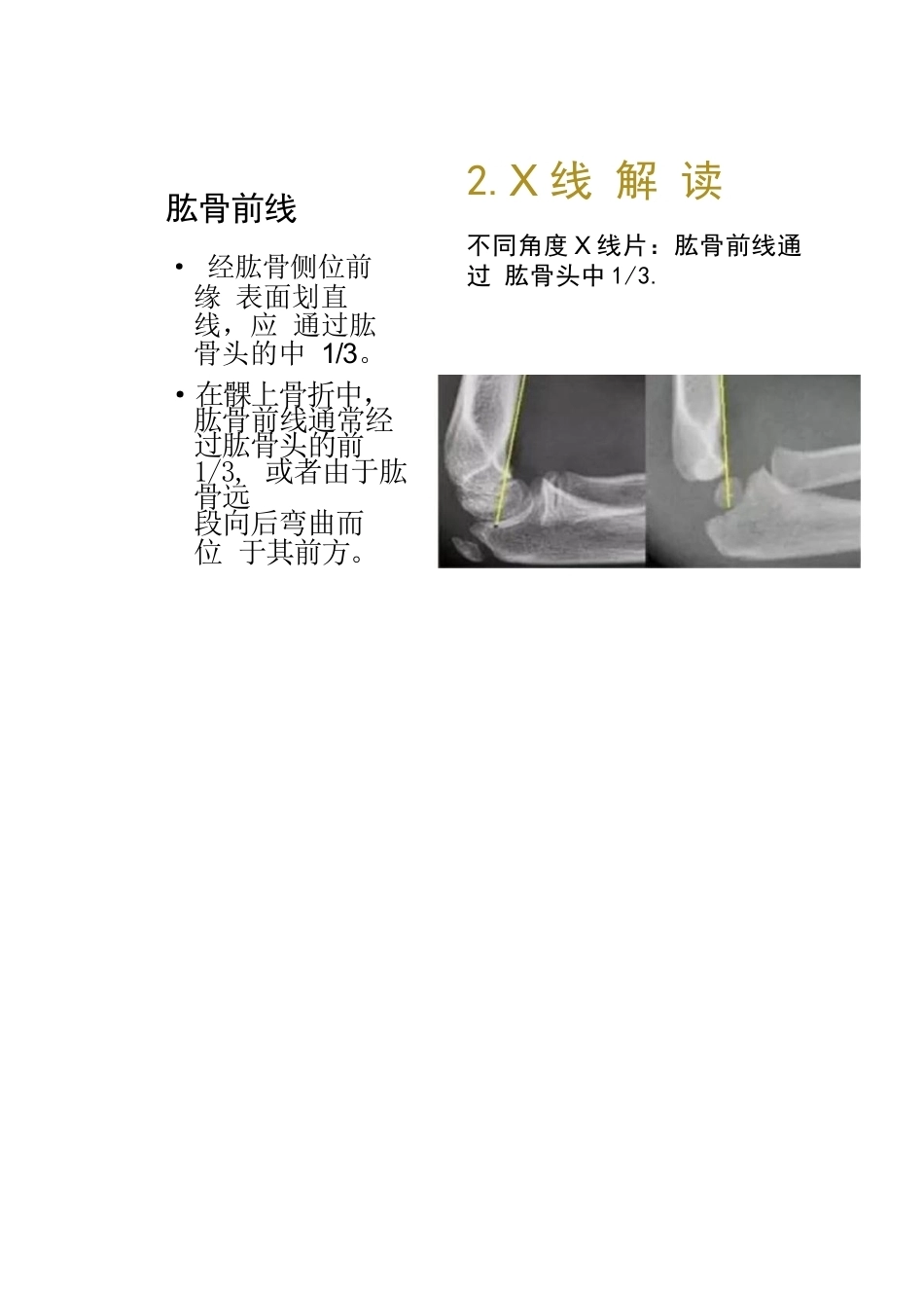 儿童肘关节骨折的分类与诊断要点_第15页