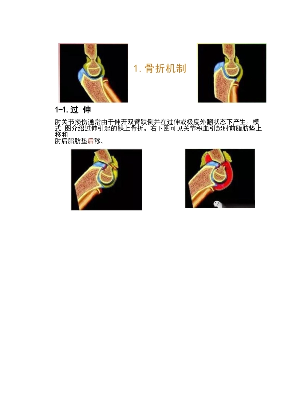 儿童肘关节骨折的分类与诊断要点_第4页