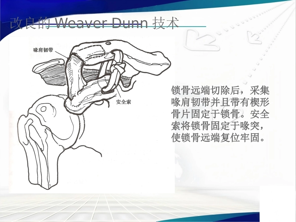 双ENDOBUTTON技术 重建肩锁关节_第10页