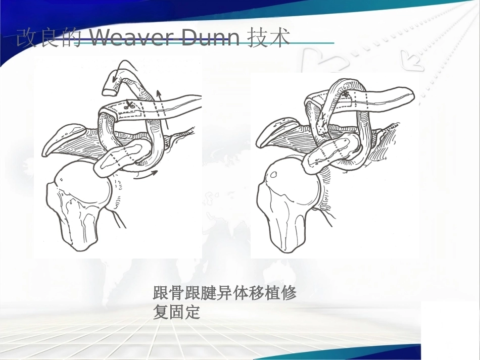 双ENDOBUTTON技术 重建肩锁关节_第12页