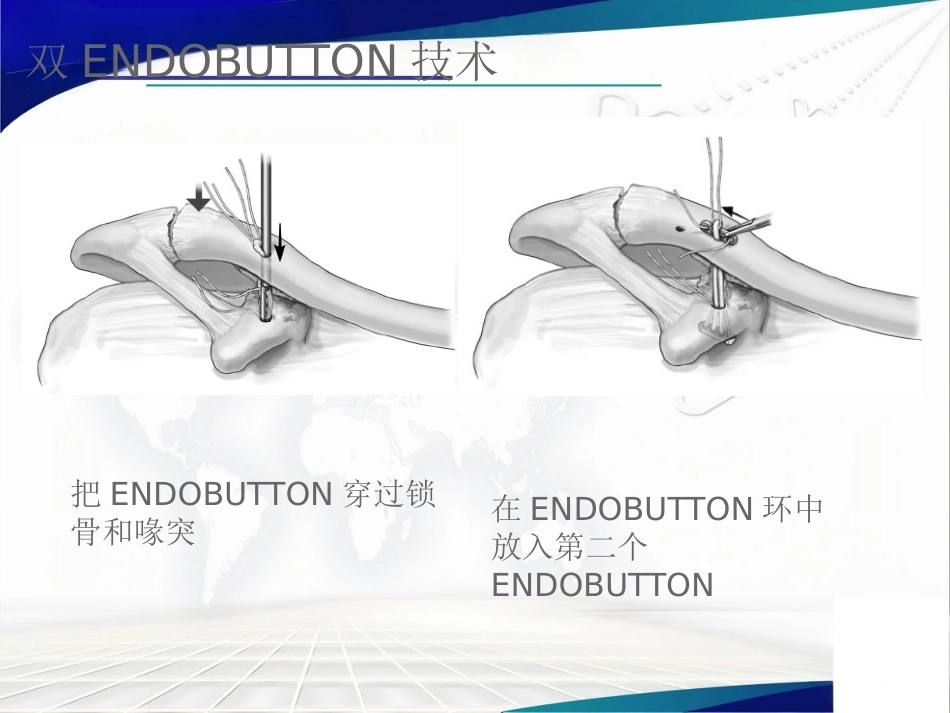 双ENDOBUTTON技术 重建肩锁关节_第15页