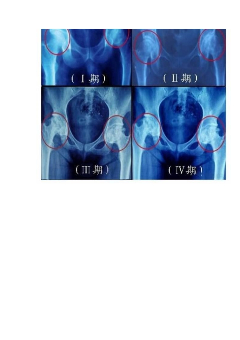 股骨头缺血性坏死的分期及诊断要点_第11页
