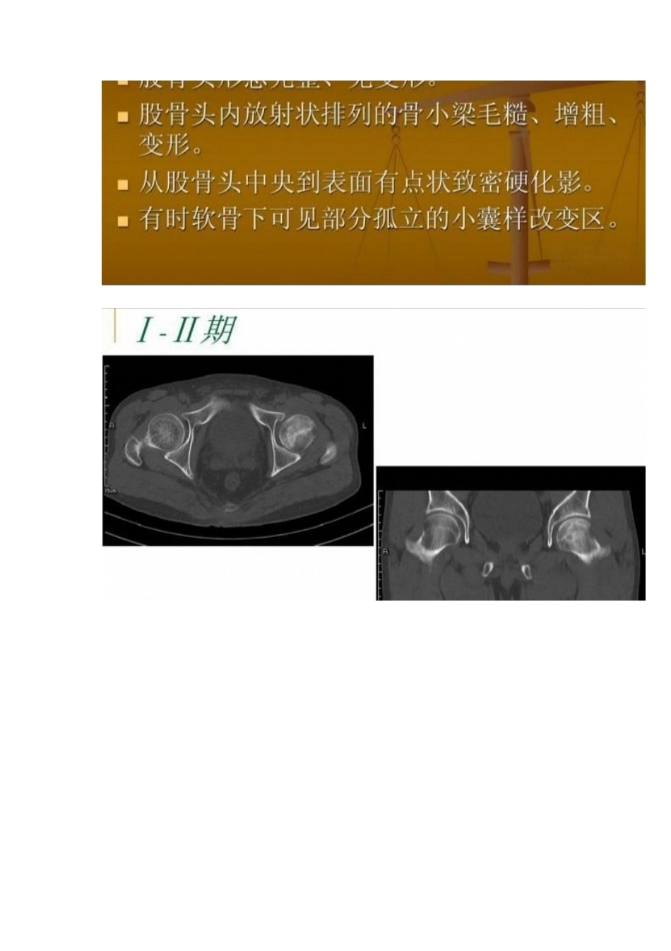 股骨头缺血性坏死的分期及诊断要点_第12页