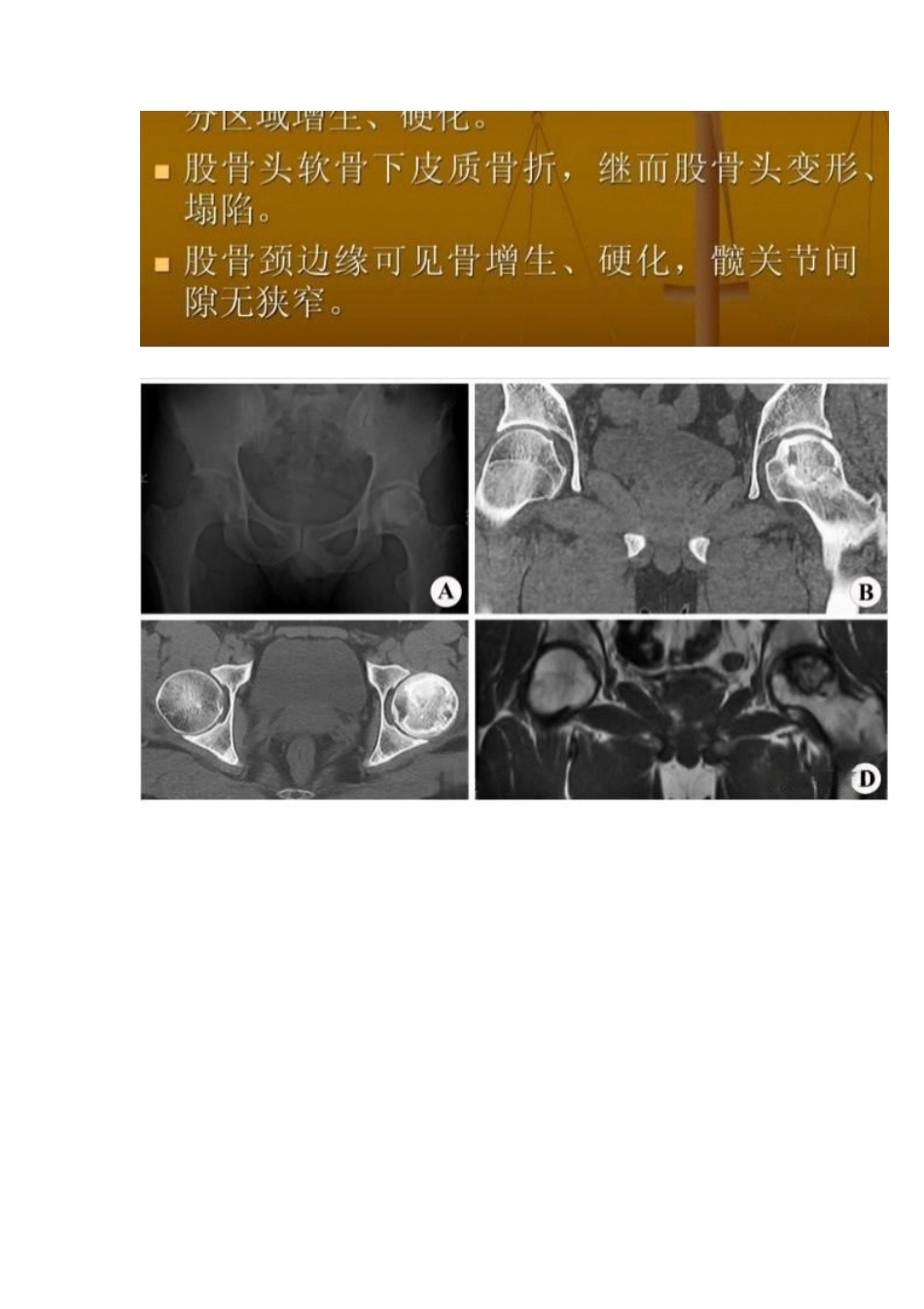 股骨头缺血性坏死的分期及诊断要点_第14页