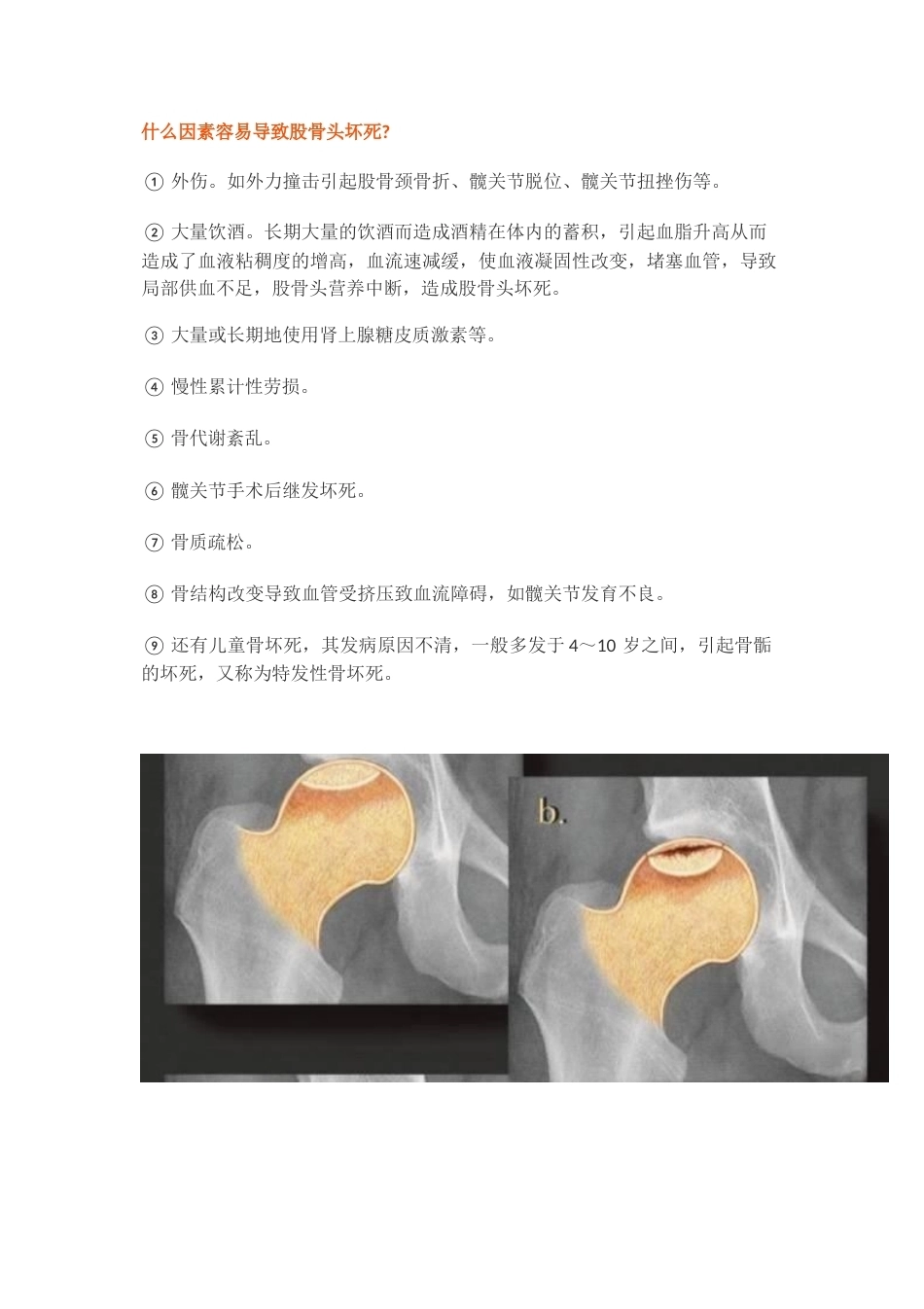 股骨头缺血性坏死的分期及诊断要点_第3页