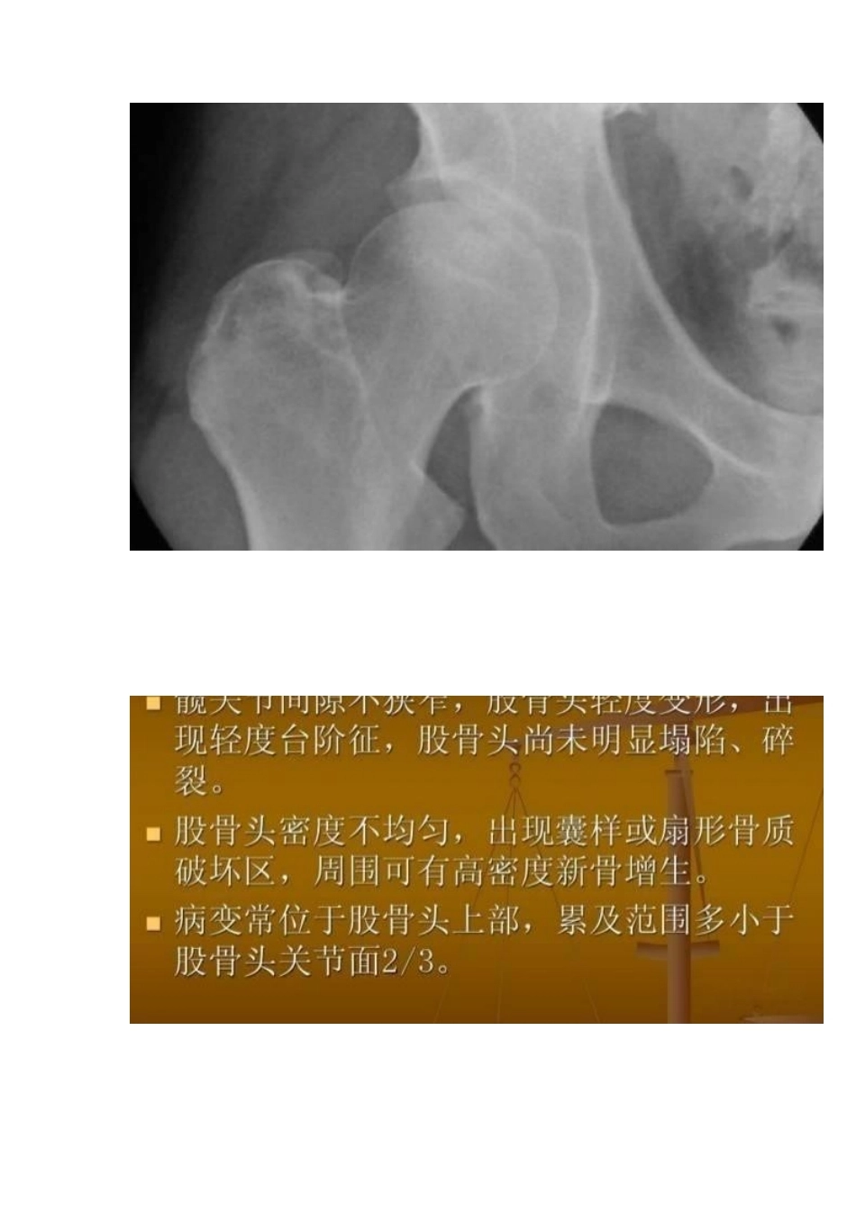 股骨头缺血性坏死的分期及诊断要点_第8页