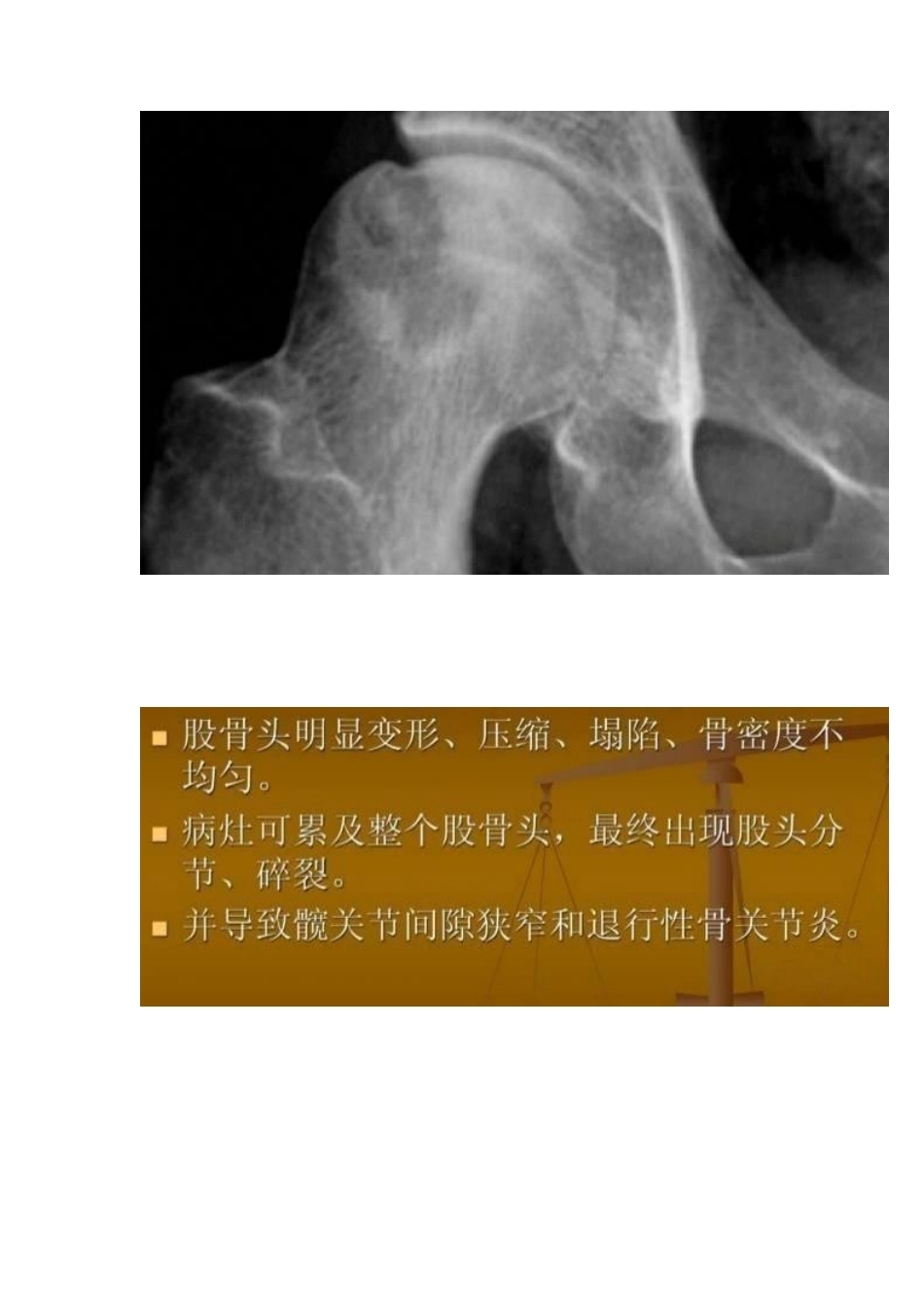 股骨头缺血性坏死的分期及诊断要点_第9页