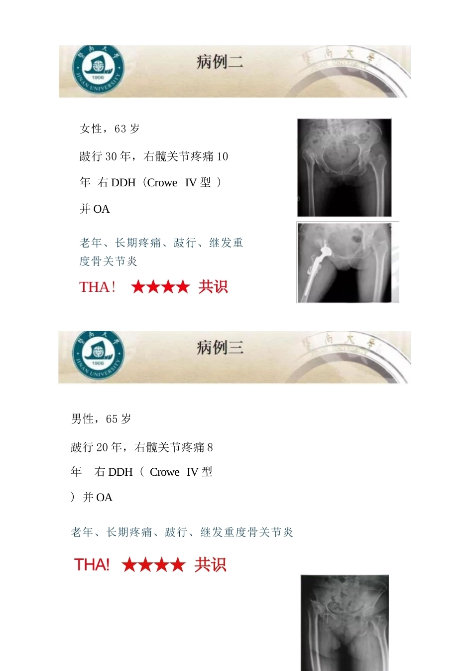 DDH全髋 关节置换术的适应症及禁忌症_第4页