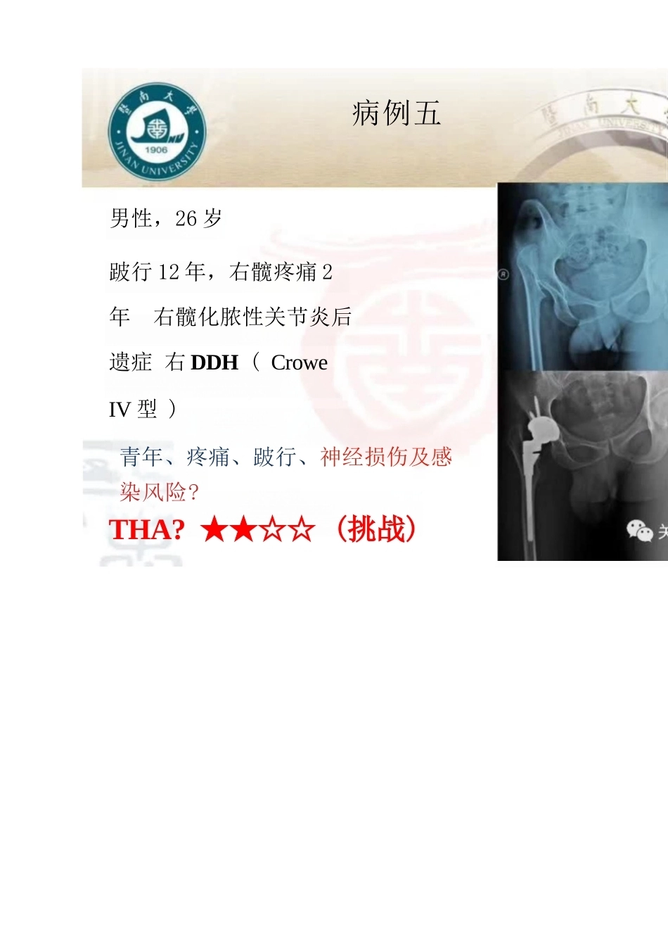 DDH全髋 关节置换术的适应症及禁忌症_第7页