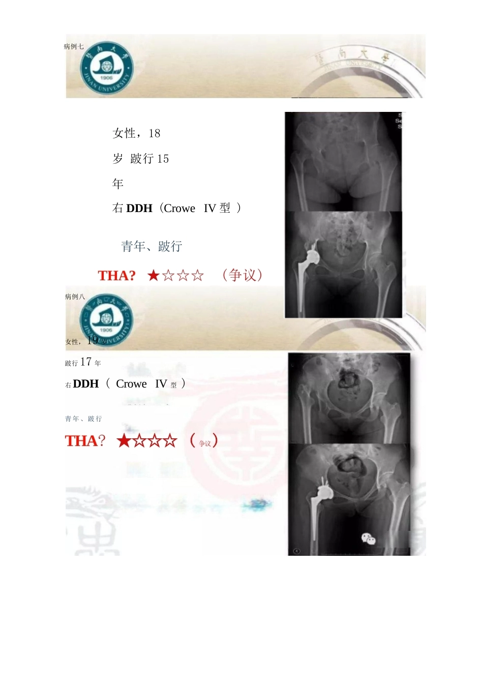 DDH全髋 关节置换术的适应症及禁忌症_第9页
