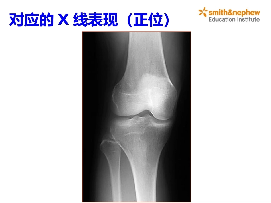 膝关节周围解剖与手术 入路_第6页