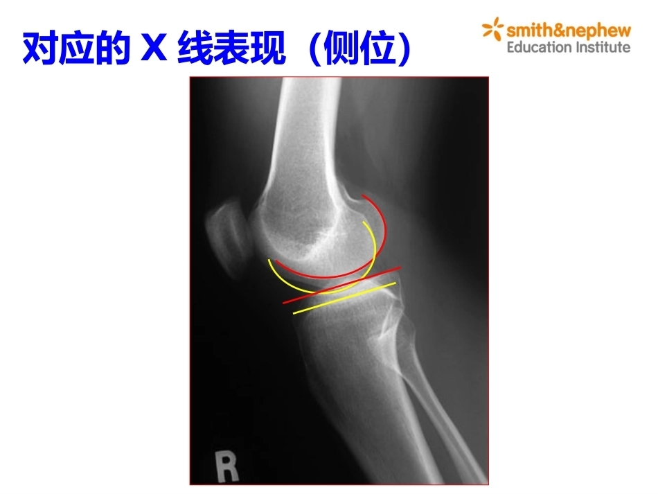 膝关节周围解剖与手术 入路_第7页