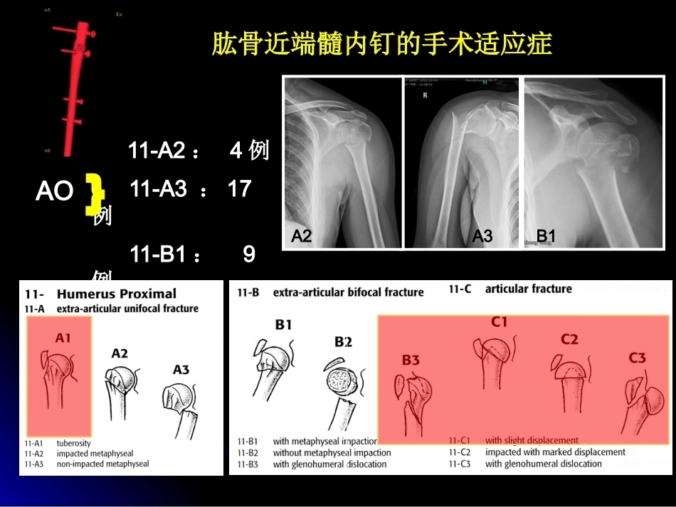 肱骨近端骨折髓内钉治疗_第13页