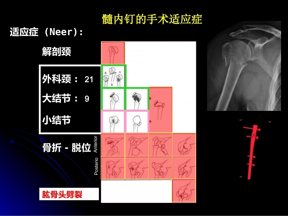 肱骨近端骨折髓内钉治疗_第14页