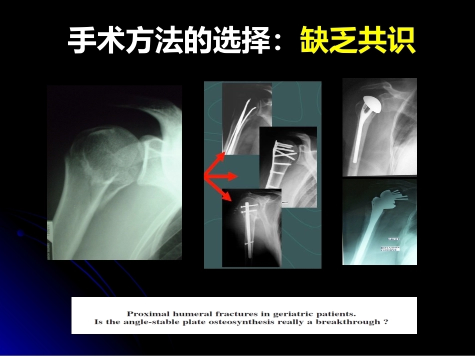 肱骨近端骨折髓内钉治疗_第3页