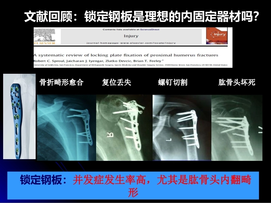 肱骨近端骨折髓内钉治疗_第4页