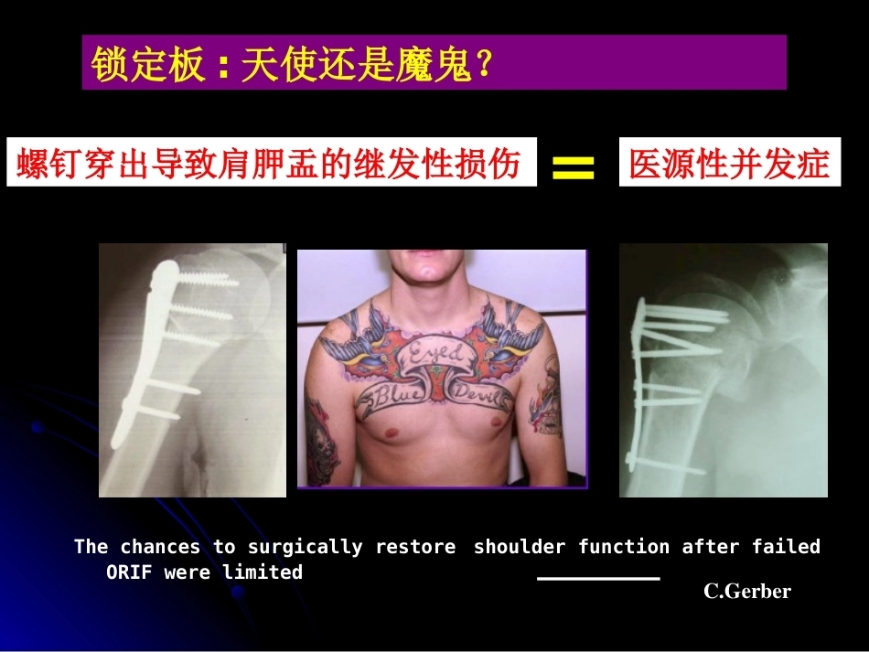 肱骨近端骨折髓内钉治疗_第5页