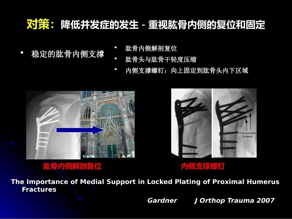 肱骨近端骨折髓内钉治疗_第6页