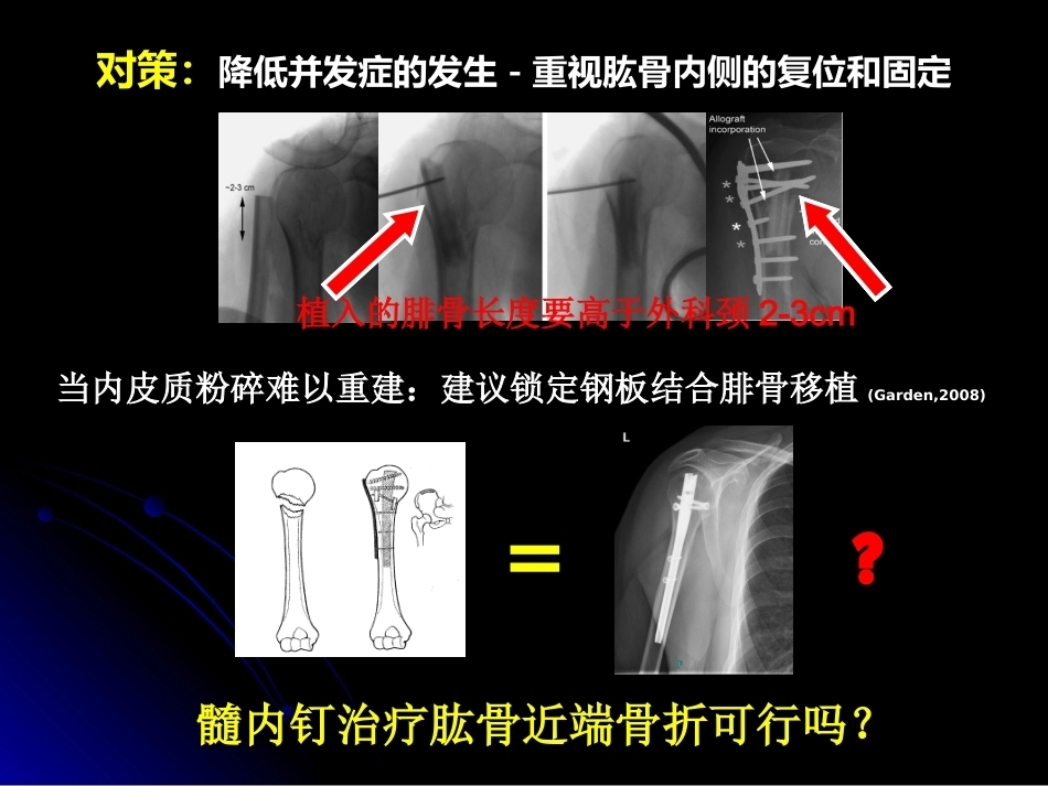 肱骨近端骨折髓内钉治疗_第7页