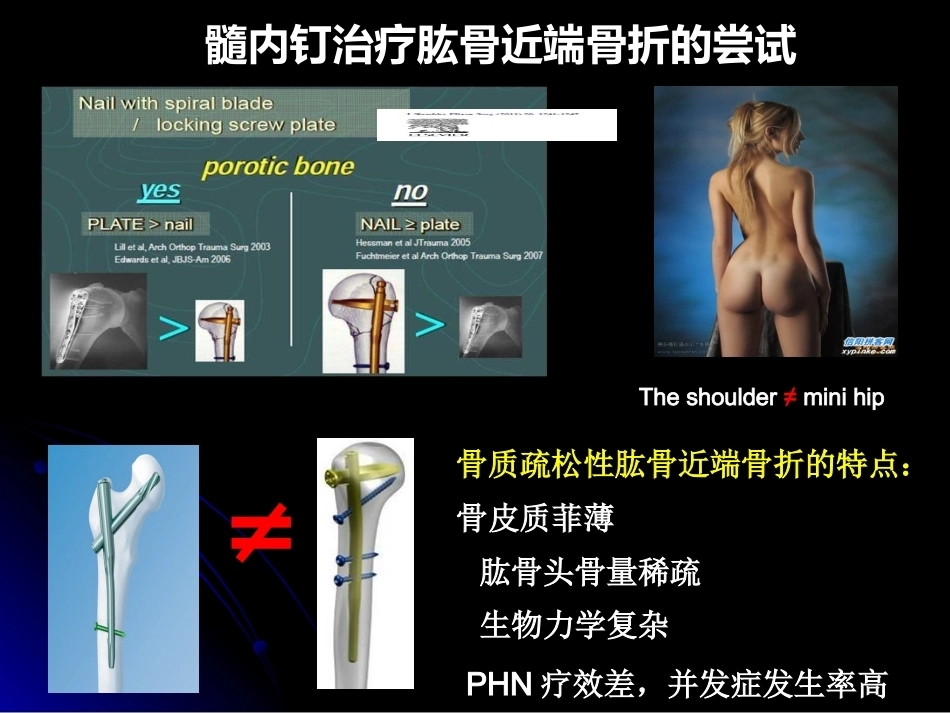 肱骨近端骨折髓内钉治疗_第8页