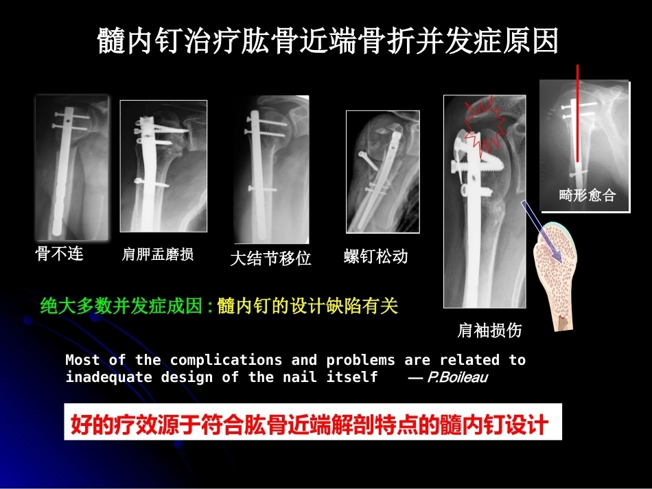 肱骨近端骨折髓内钉治疗_第9页