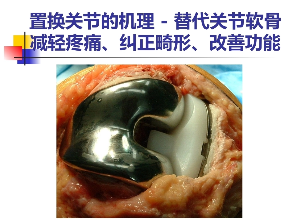全膝关节 置换术_第10页