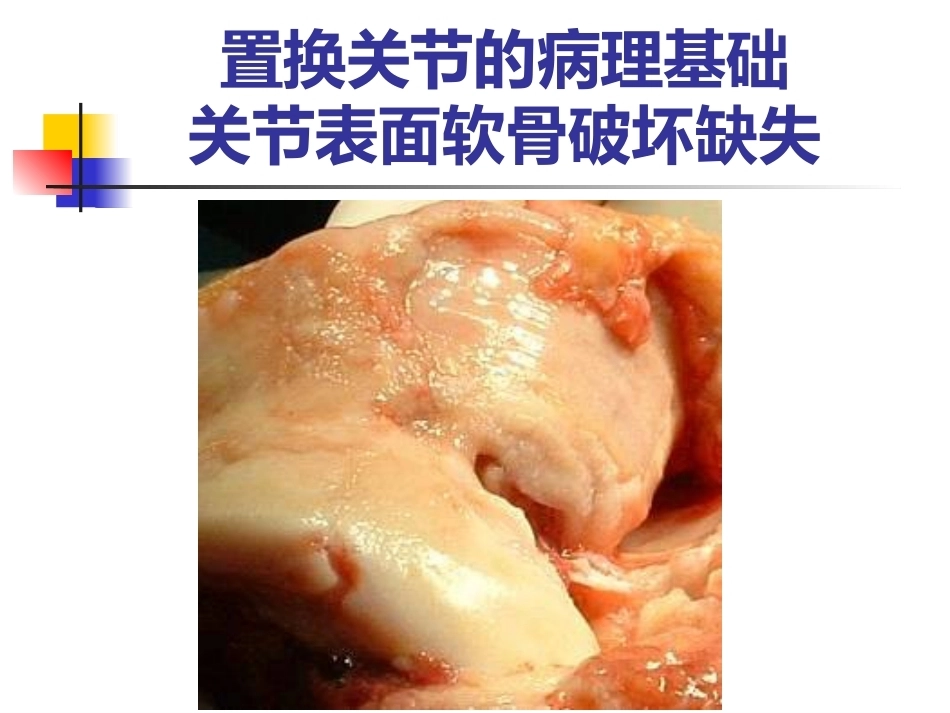 全膝关节 置换术_第7页