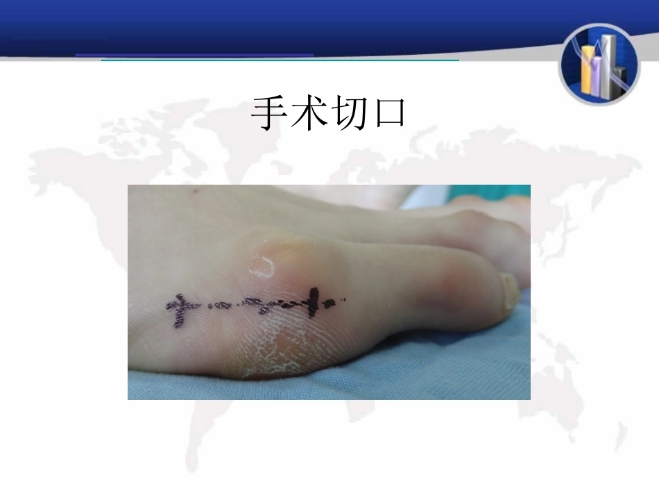 小趾囊 炎_第12页